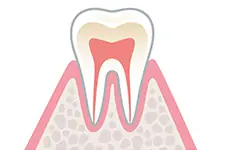 C0（初期虫歯）のイメージ