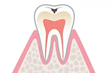 C1（エナメル質の虫歯）のイメージ