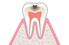 C2（象牙質の虫歯）のイメージ