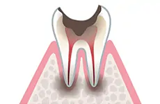 C4（歯の根だけ残った状態）のイメージ