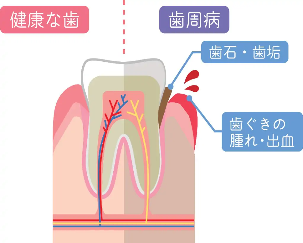 歯周病の原因と進行